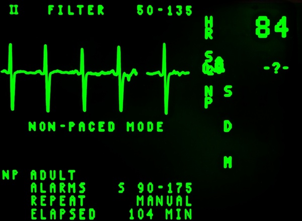 electrocardiogram beat cardiology