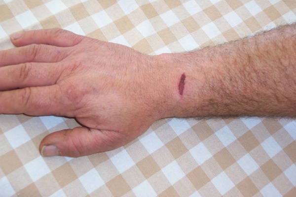 gash wound on arm