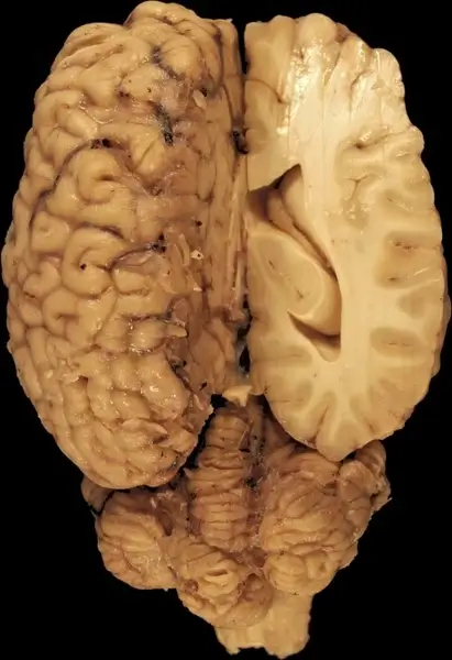 brain anatomy eyes