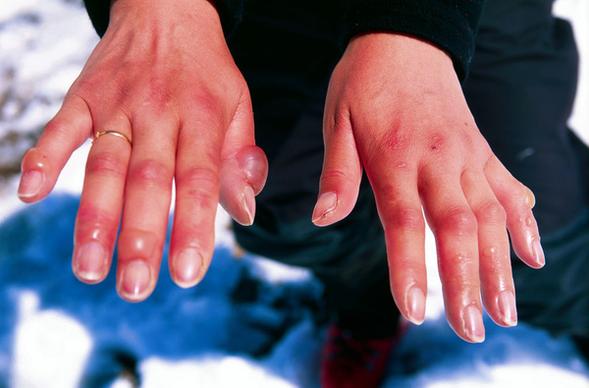margs fingers after the descent of aconcagua
